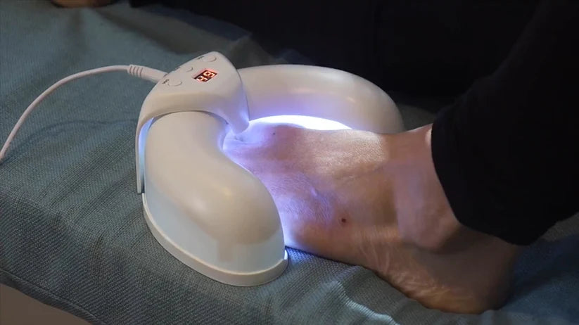 Nail Fungus Remover Laser Therapy